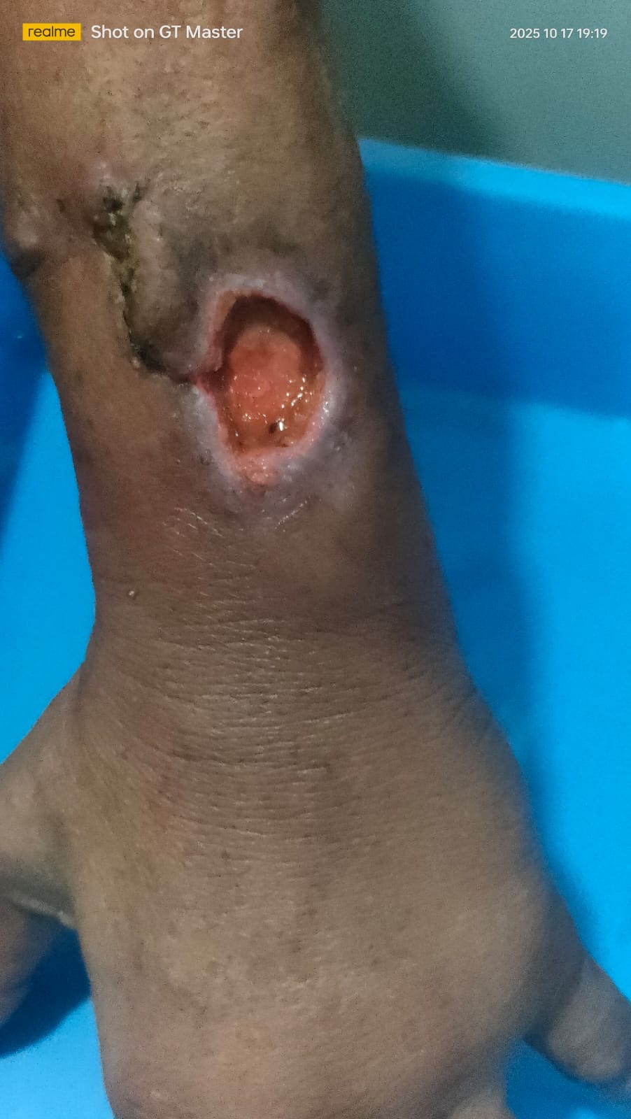 Chronic Wound Healing - Before treatment