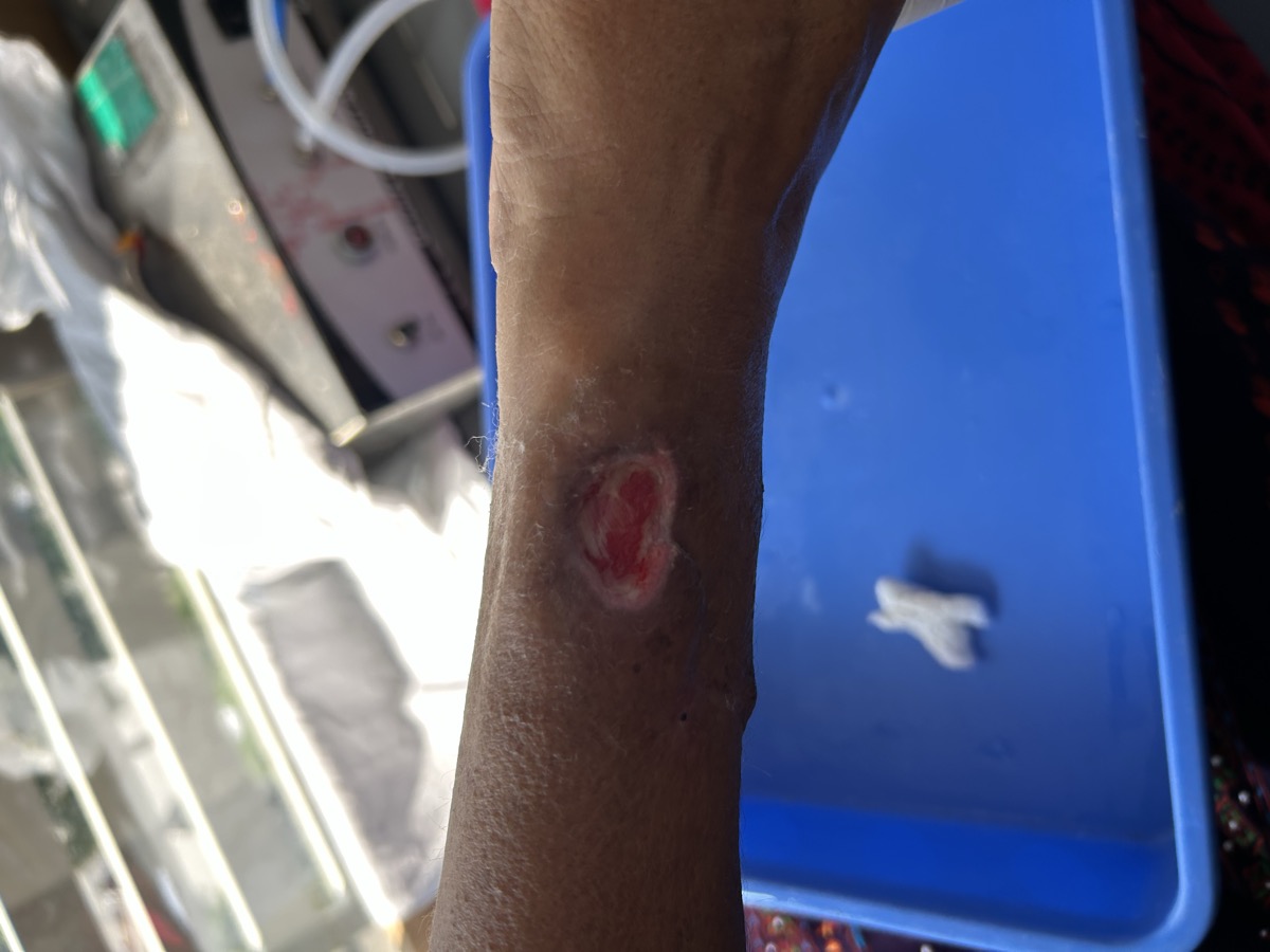 Chronic Wound Healing - During treatment